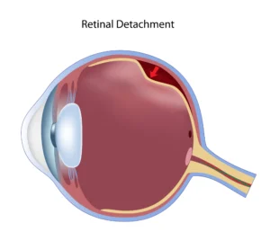 Retinal Detachment: Warning Signs