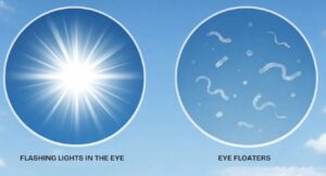 Floaters vs. Flashes: What’s the Difference?