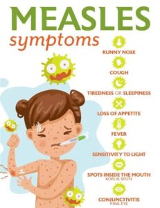 Measles: Symptoms and Prevention